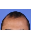 Before Hair Transplant &nbsp;2 Sessions (Areas)